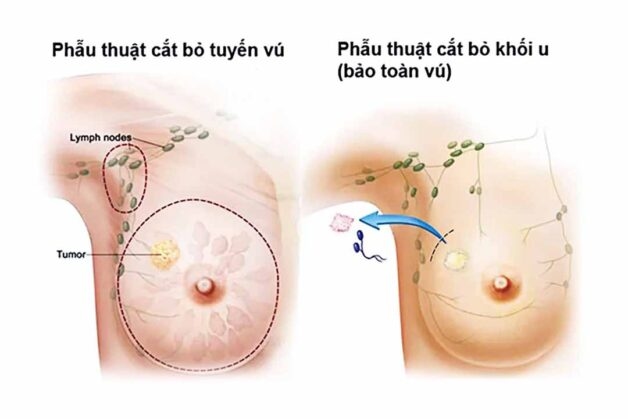 Birads 4 Có Nguy Hiểm Không