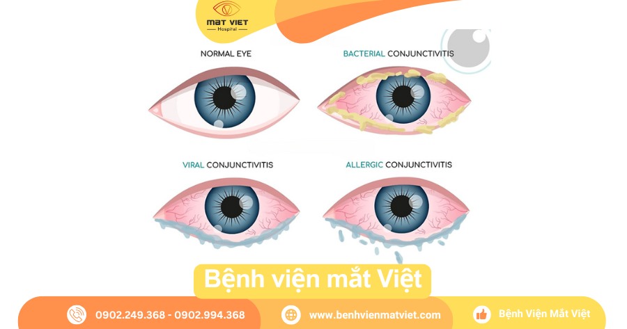 Conjunctivitis Là Gì