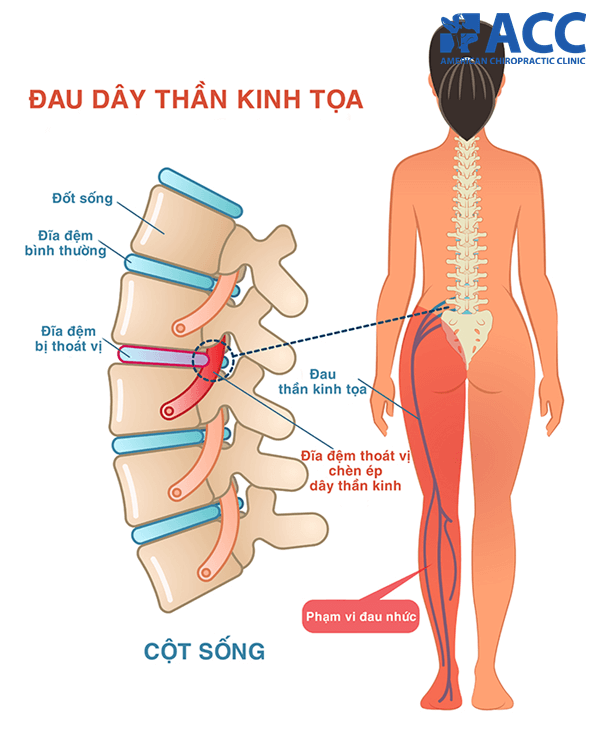 Dấu Hiệu đau Thần Kinh Tọa