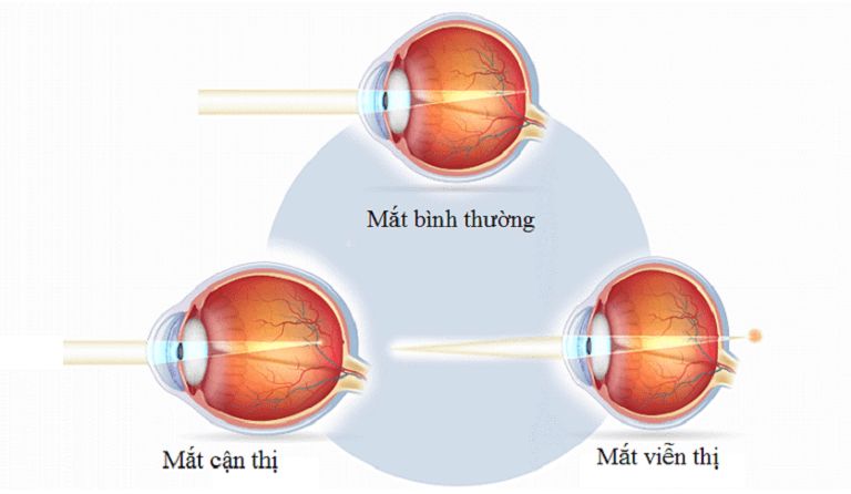 đối Với Mắt Viễn Thị Thì