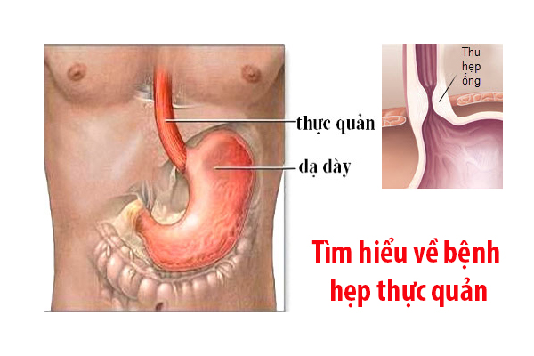 Hẹp Thực Quản