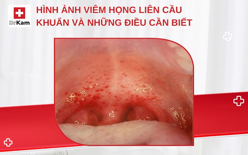Hình ảnh Viêm Họng Liên Cầu Khuẩn