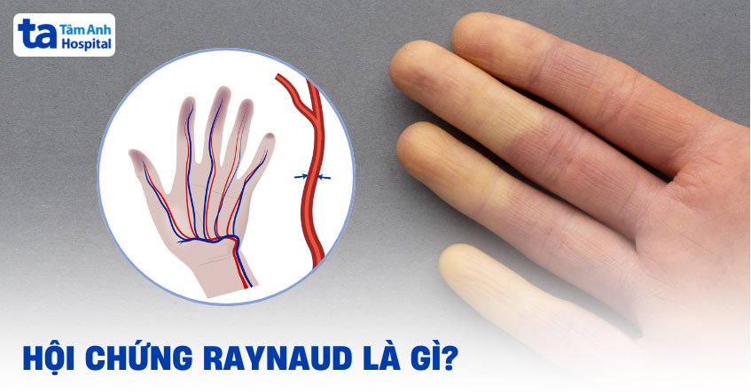 Hội Chứng Raynaud Là Gì