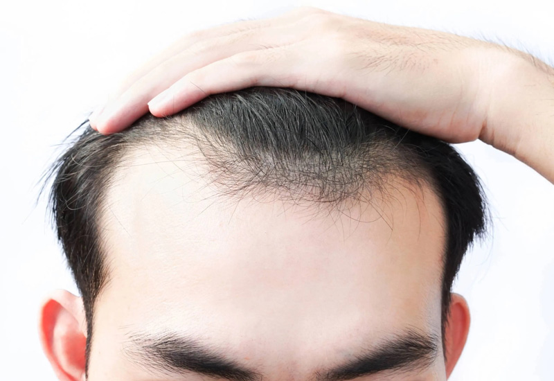 Hói Có Di Truyền Không