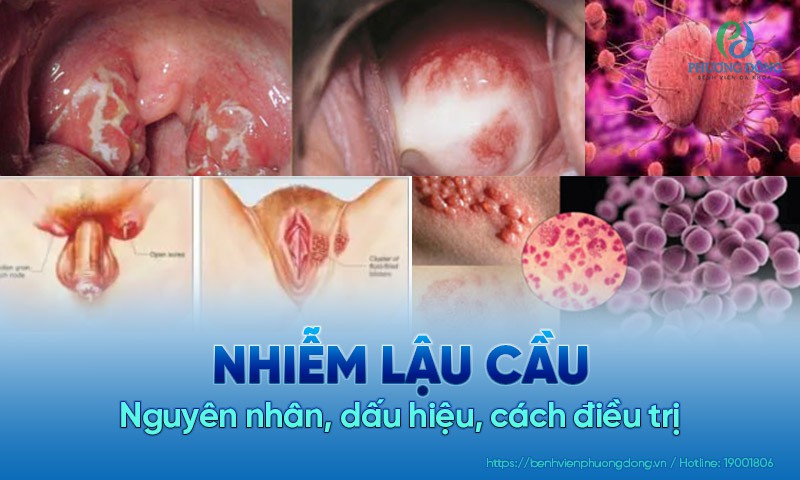Lậu Cầu Là Gì