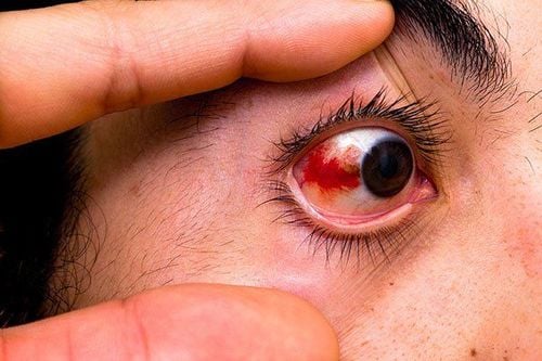 Mắt đỏ Là Bị Gì