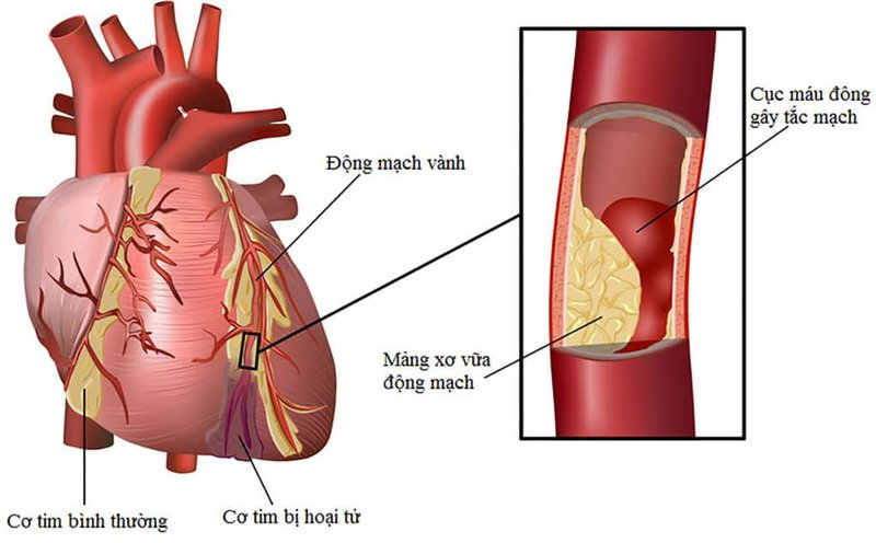 Nguyên Nhân Tim đập Nhanh