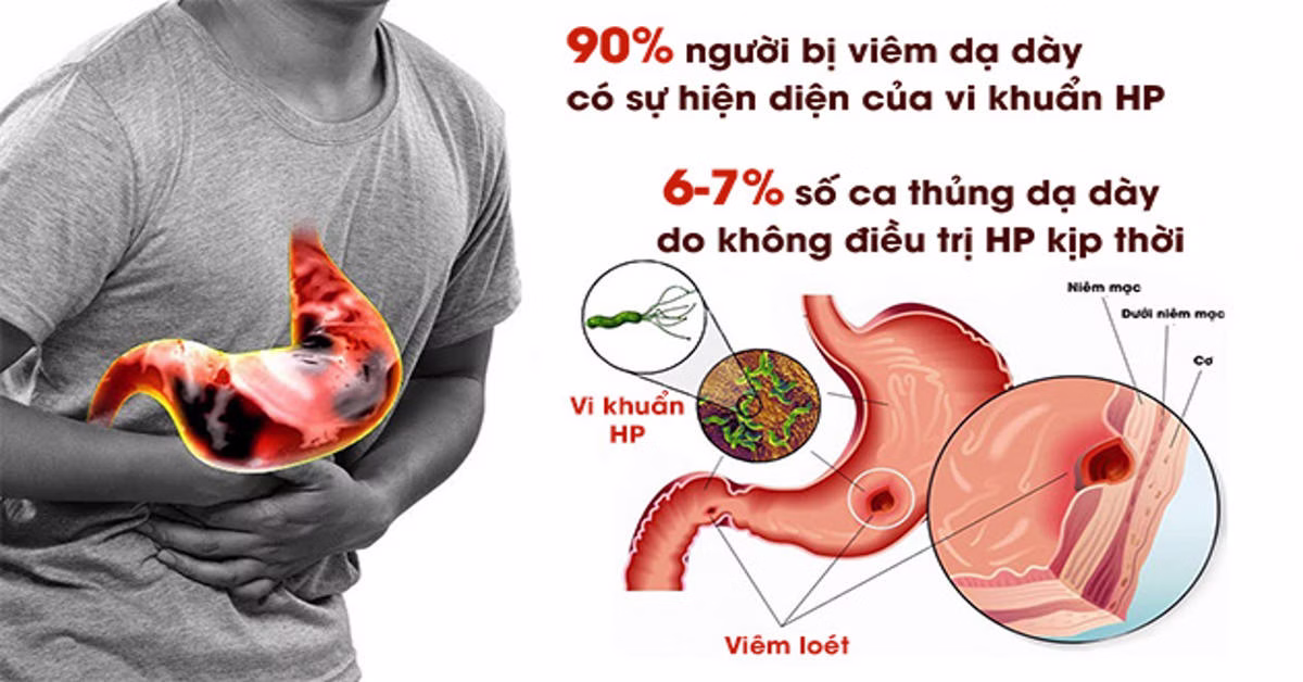 Nhiễm H Pylori