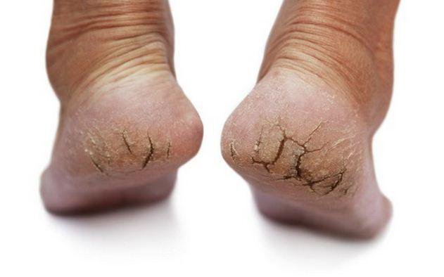Nứt Gót Chân Phải Làm Sao