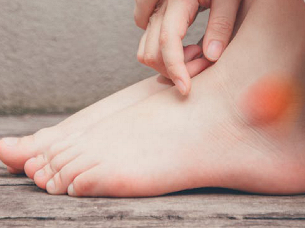 Phù Mắt Cá Chân