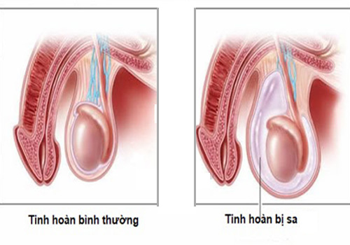Sa Tinh Hoàn