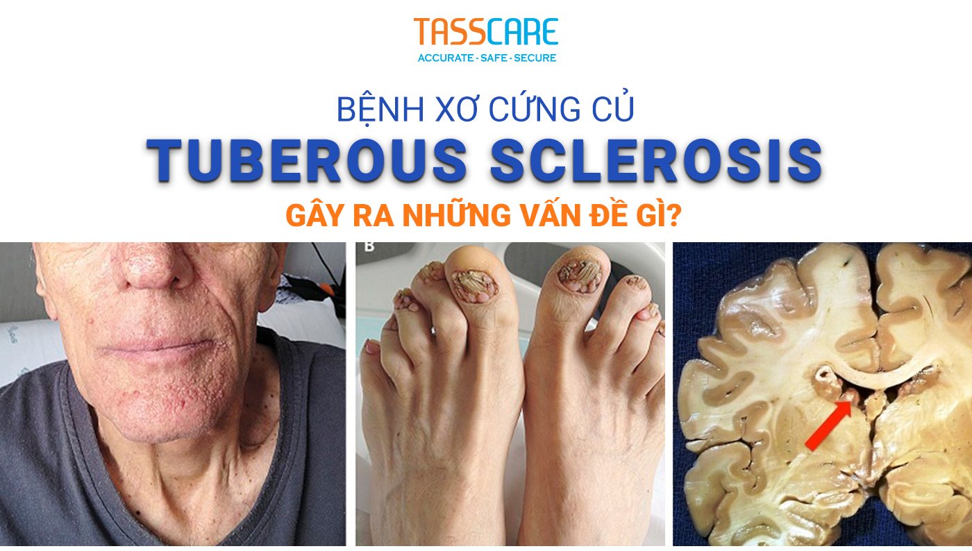 Sclerosis Là Gì