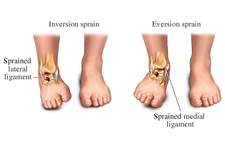 Sprain Là Gì