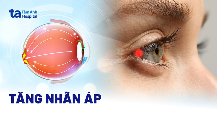 Tăng Nhãn áp Triệu Chứng