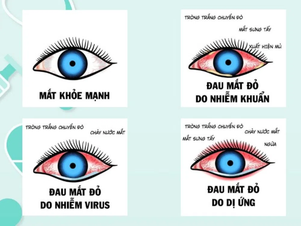 Triệu Chứng Viêm Kết Mạc