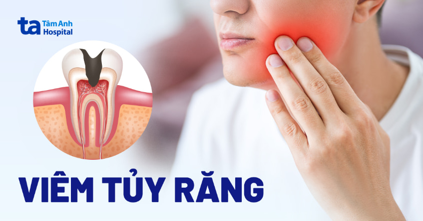 Triệu Chứng Viêm Tủy Răng