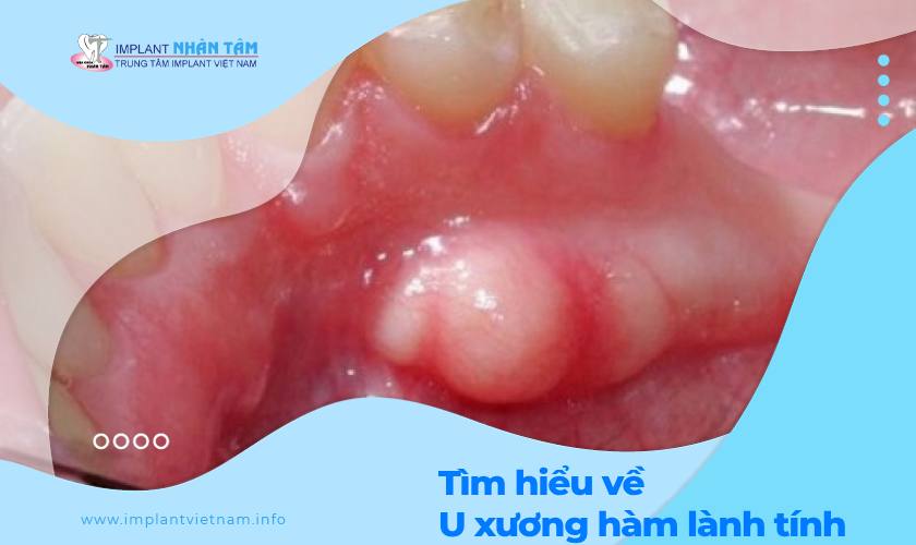 U Xương Hàm Dưới