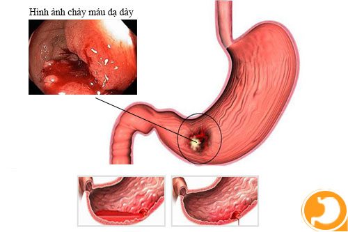 Viêm Hang Vị Xung Huyết