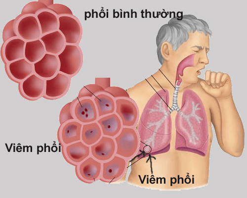 Viêm Phổi Tiếng Anh