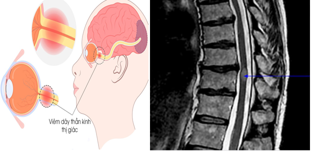 Viêm Tủy Thị Thần Kinh