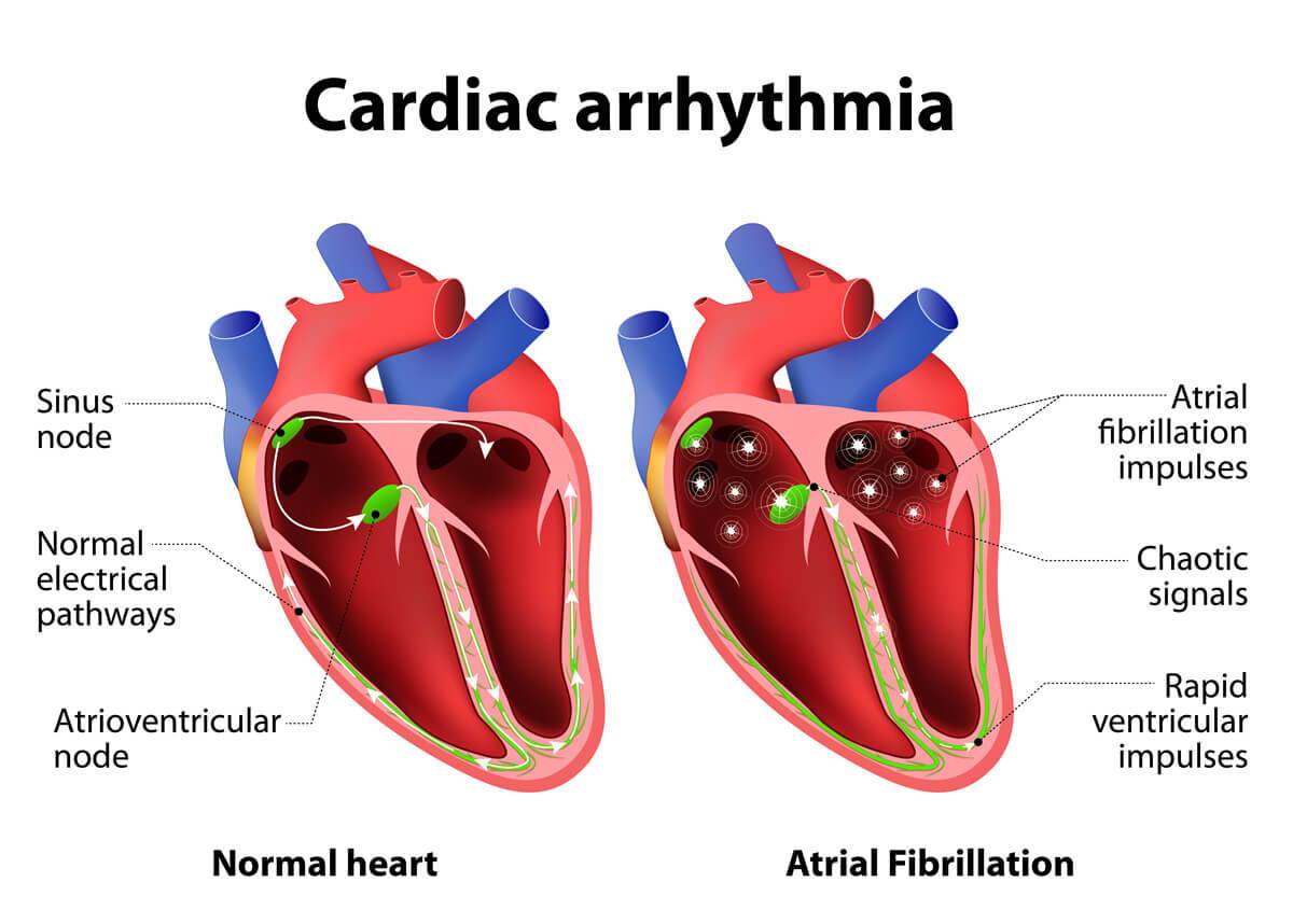 Arrhythmia Là Gì