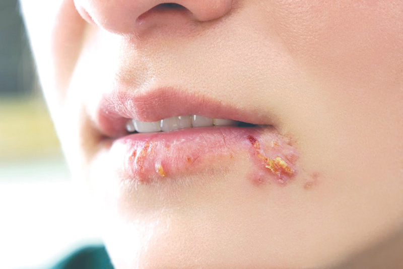 Bệnh Herpes Là Gì