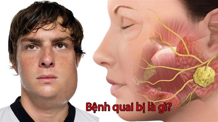 Bệnh Quai Bị Là Bệnh Gì