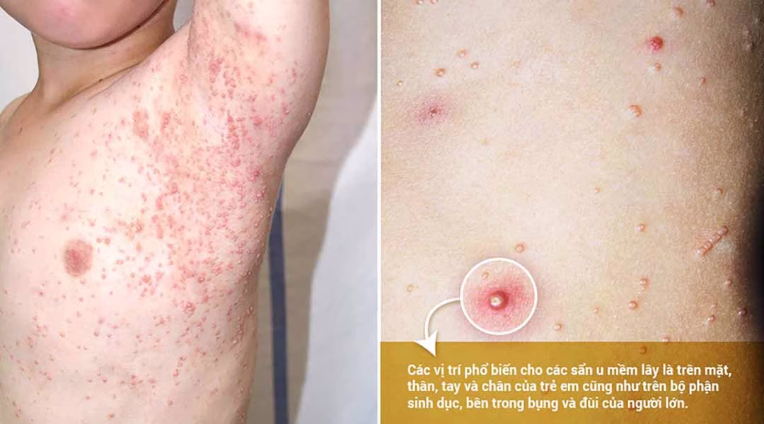 Bệnh U Mềm Lây