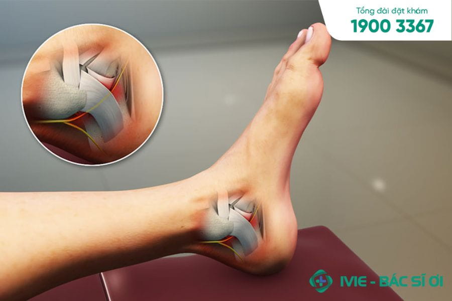 Bị đau Phía Trên Gót Chân