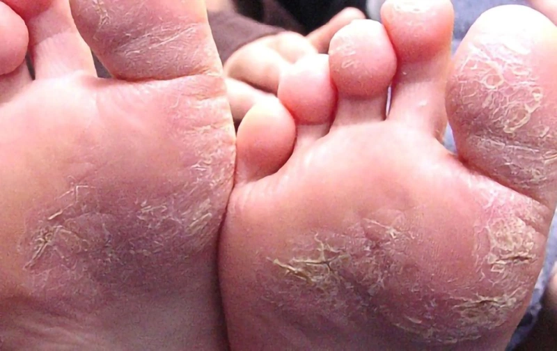 Chân Bị Nứt Nẻ
