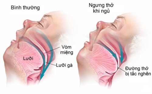 Chứng Ngưng Thở Khi Ngủ