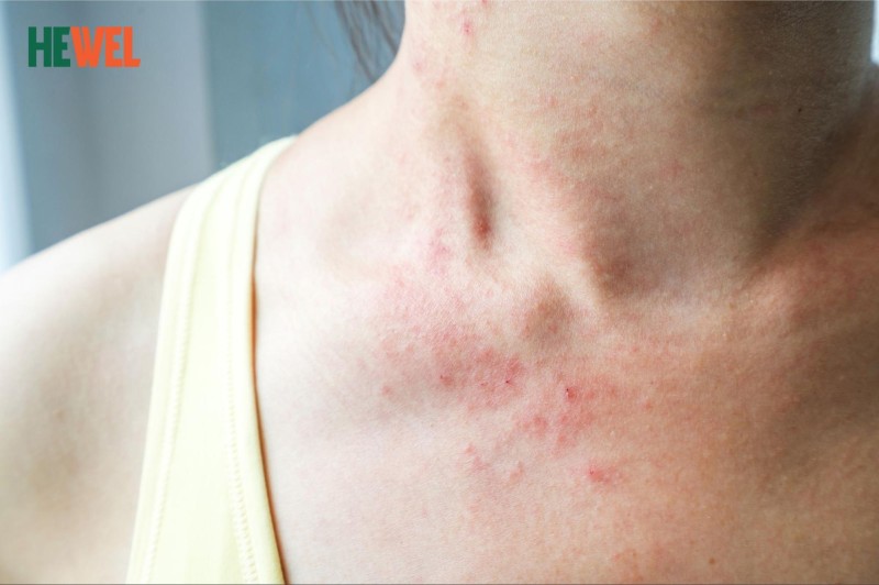 Dấu Hiệu Nóng Trong Người