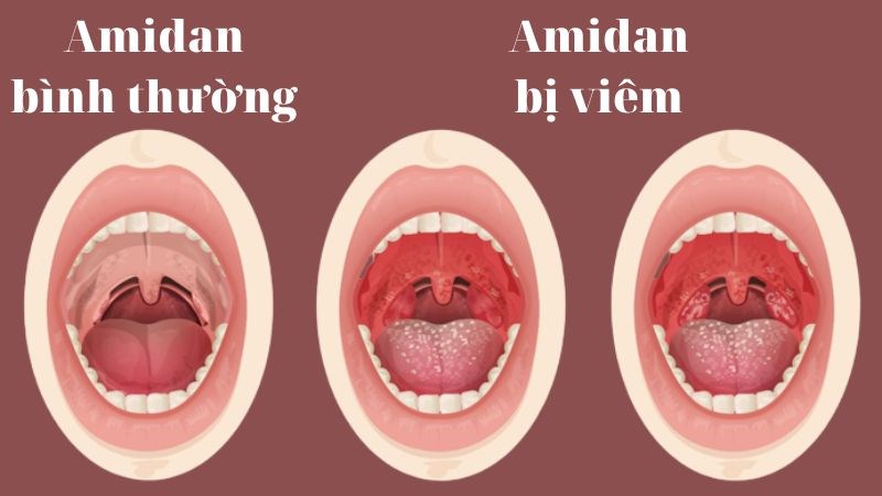 điều Trị Viêm Amidan