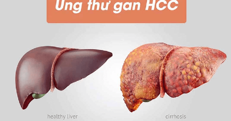 Hcc Gan Là Gì