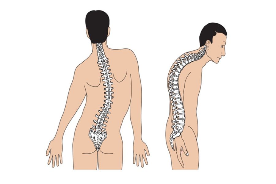 Lệch Cột Sống
