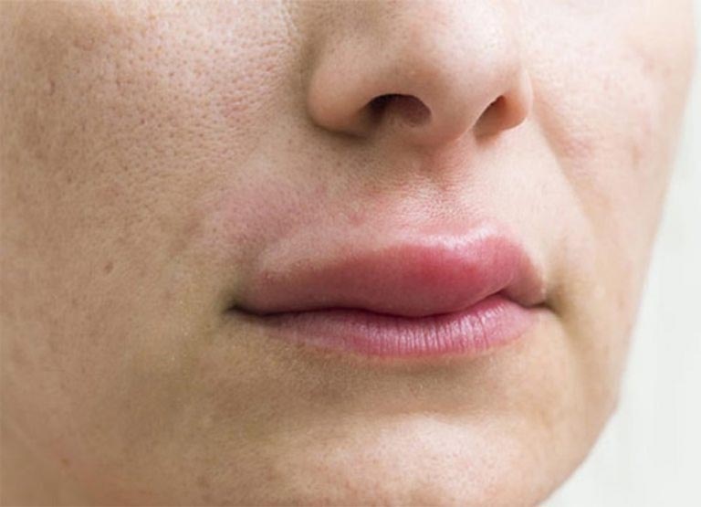 Môi Tự Nhiên Sưng Lên Là Bệnh Gì
