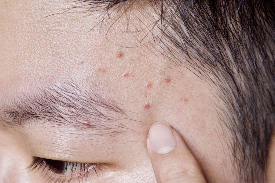 Mụn 2 Bên Thái Dương
