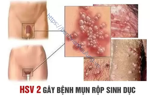 Mụn Rộp Sinh Dục Herpes