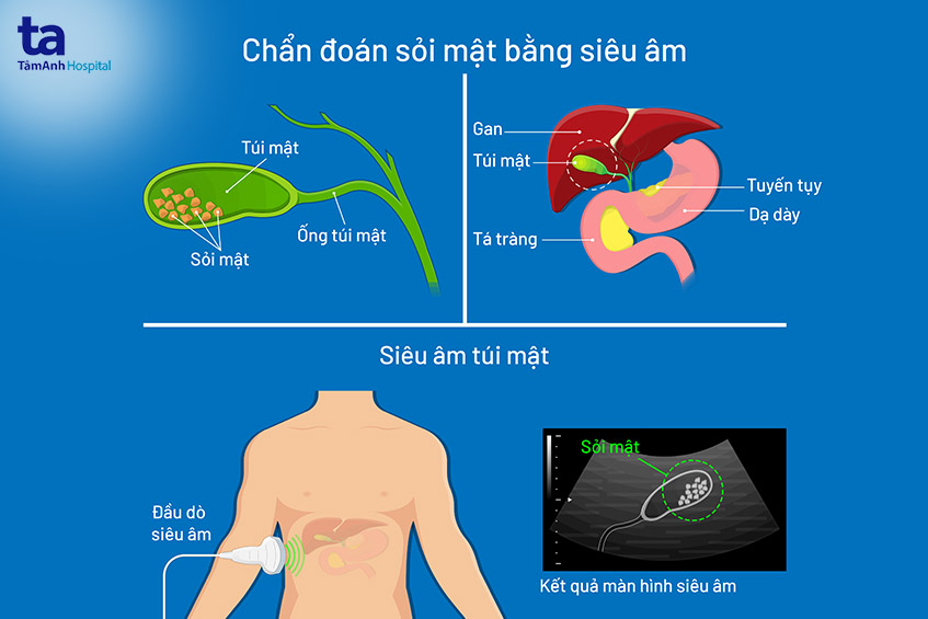 Nguyên Nhân Gây Sỏi Mật