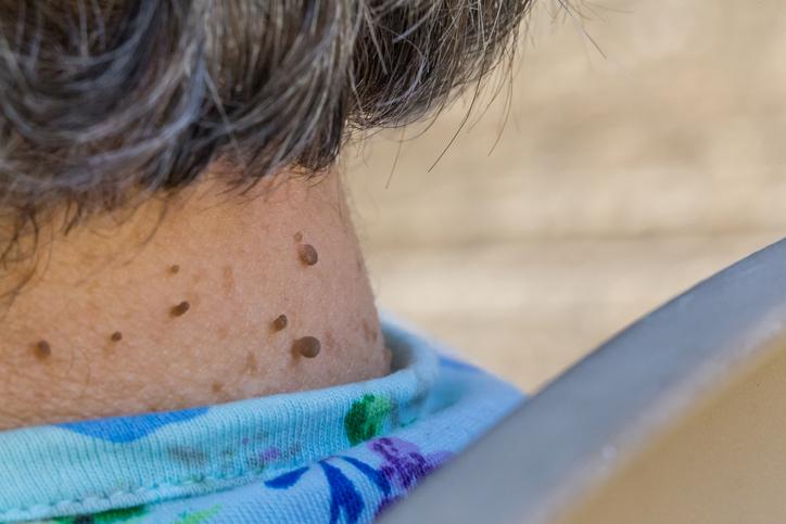 Skin Tag Là Gì