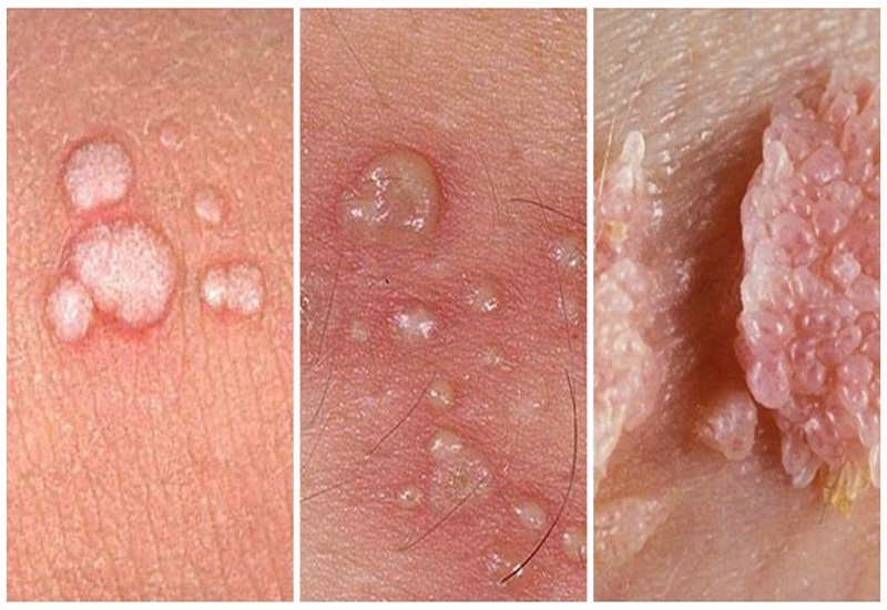 Sùi Mào Gà Triệu Chứng