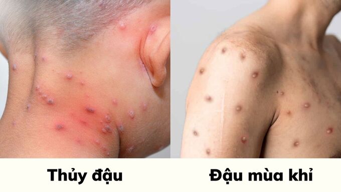 Thủy đậu Khỉ