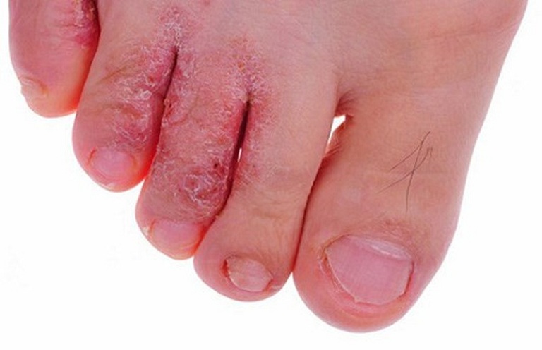 Tổ đỉa Có Lây Không
