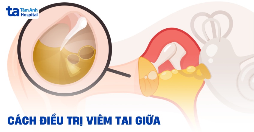 Trị Viêm Tai Giữa