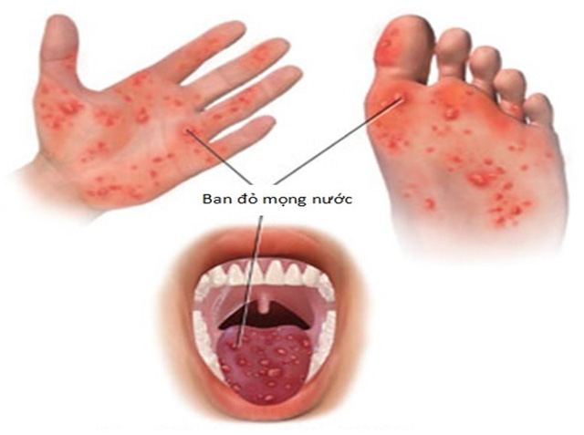 Triệu Chứng Của Bệnh Tay Chân Miệng