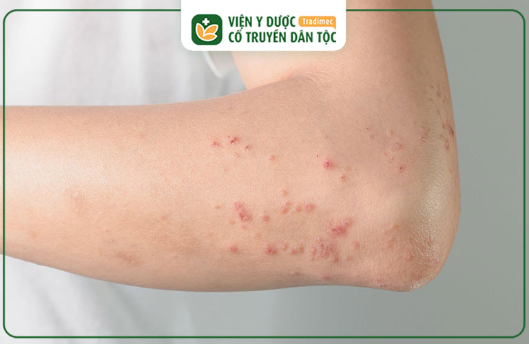 Viêm Da Cơ địa Nổi Mụn Nước