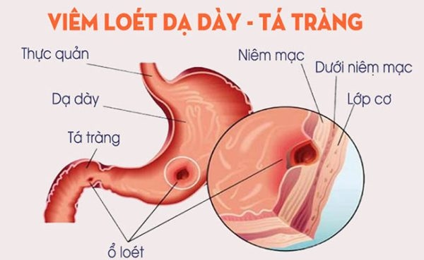 Viêm Tá Tràng Là Gì