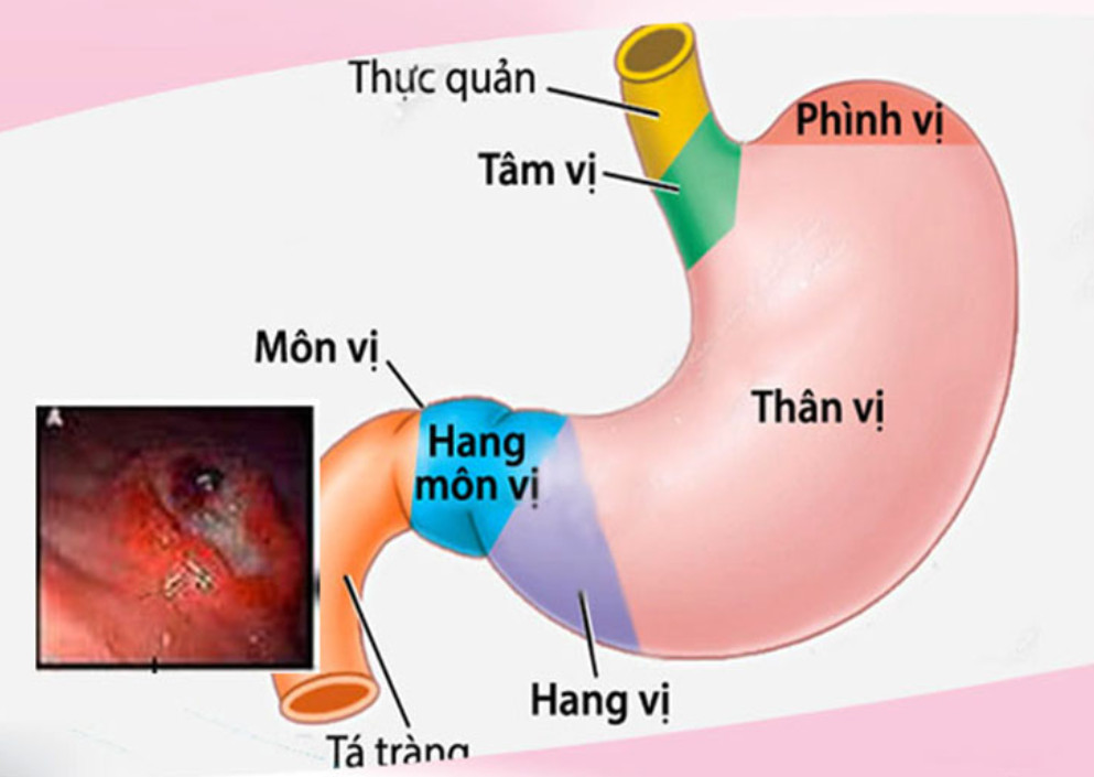 Viêm Xung Huyết Hang Môn Vị