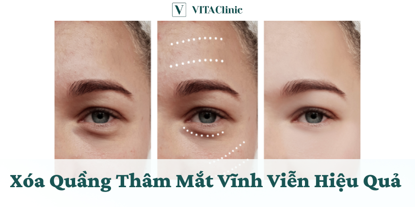 Xóa Thâm Mắt
